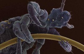 虱子卵为何如此难除？(去除虱子卵最好小窍门