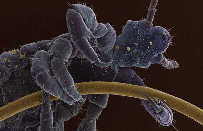 虱子卵为何如此难除